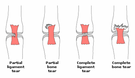 Ligament and Tendon Injuries